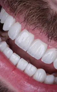 جشنواره دندانپزشکی وایمپلنت باروکش رایگان