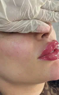 تخفیف ویژه چال لپ ، فیلر ، بوتاکس ، جوانسازی