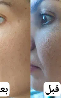 پاکسازی و جوانسازی پوست و صورت