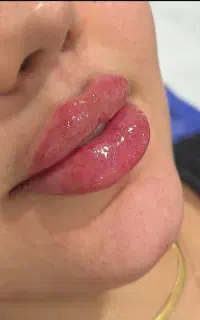 بوتاکس وژل چالگونه آنزیم مزوفیلربادی خانم سیاهی
