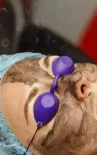 هایفو لاغری کربن تراپی فشیال پی ار پی امبدینگ
