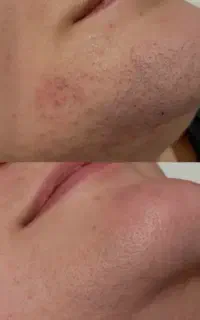 لیزر موهای زائد از بین بردن داعمی موها با کندلا