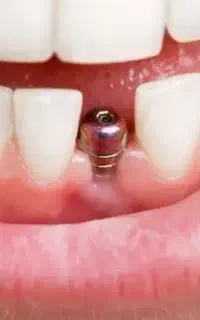 مرکزفوق تخصصی ایمپلنت دیجیتال مشهد/سبک کاخ لبخند