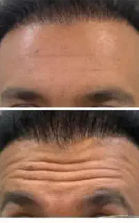 تخفیف بوتاکس و فیلر در مطب پزشک
