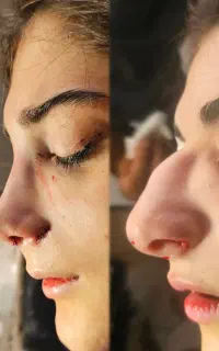 آف جراحی بینی ۲۰ت ولیپوساکشن وابدودراهواز