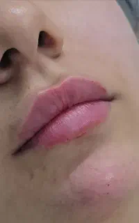تزریق بوتاکس فیلر ژل لب آنزیم لب توسط پزشک