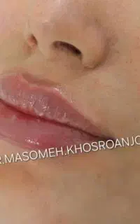 آف فیلر لب هر سی سی فقط ۳/۵ میلیون تزریق توسط پزشک