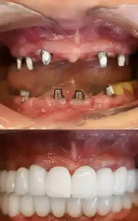 ایمپلنت ایرانی تحت لیسانس کره ۶۵۰۰