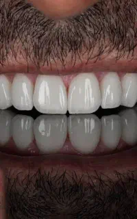 کامپوزیت فکی 12 میلیون/اقساط با سفته و چک صیادی