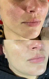 روشن سازی صورت با لیزر