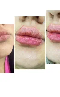 ژل‌فیلر‌بوتاکسPRP جوانسازوروشن کننده700صورت و لیزر