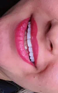 کامپوزیت و تخفیف