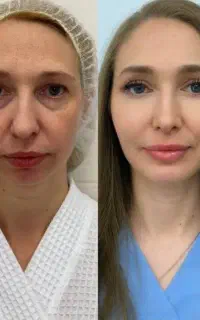 بوتاکس ژل-مزو-پی آر پی لیفت بانخ-فشیال-اسکالپ
