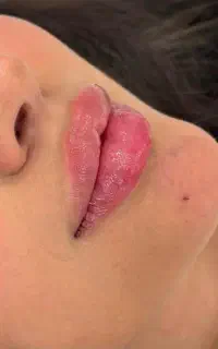 ژل رووفیل کره ،بوتاکس مصپورت (تخفیف ویژه)