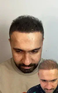 (میکرواسکالپ /اسکالپ) مزو پی آرپی  در کلینیک