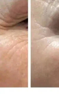 جوانسازی و لیفت بدون تزریق