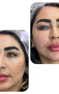 ژل و بوتاکس اصل طرح تخفیف بهاری