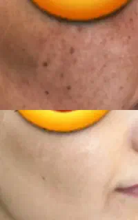 معجزه پوست با آف ویژه