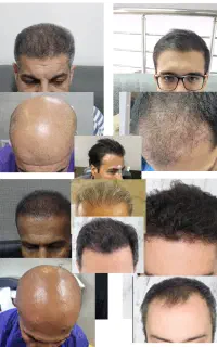 کاشت موی طبیعی با بالاترین تراکم