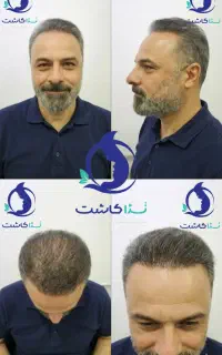 کاشت مو (میکرو و موی بلند) بدون فاکتورهای پنهان