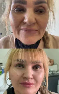 تزریق ژل بوتاکس برای خانماآقایان باقیمت باورنکردن