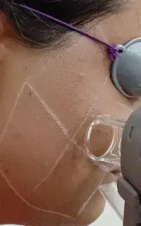 لیزر موهای زائد و خدمات زیبایی صورت