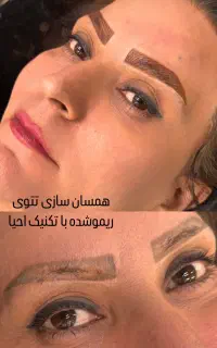 احیای انواع تتوی قدیمی و بدرنگ بدون ریمو
