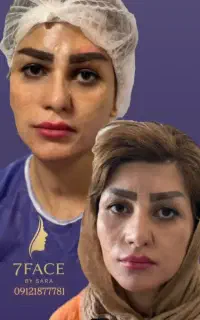 جشنواره تابستانه کاشت مو وابرو و ریش