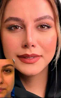بهترین تخفیف عمل بینی