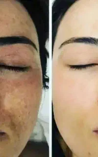 حذف تمام لک وتیرگی پوست