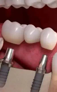 طرح قسطی دندانپزشکی وایمپلنت بدون پول پیش با وام +