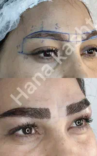 کاشت ابرو