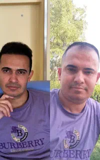 کاشت مو و ابرو شیرازی در سنندج