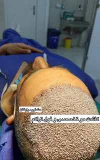 کاشت مو با قیمت اقتصادی