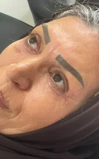 بلفاروپلاستی تخفیف ویژه  فرصت محدود