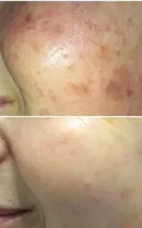 تزریق سلول‌های بنیادی