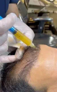 تخفیف پی آر پی و مزوتراپی توسط پزشک