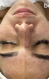 فیشال تخصصی و پاکسازی پوست