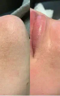 فیشال ترکیبی با مزونیدلینگ
