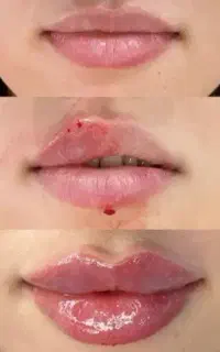 تزریق ژل و بوتاکس فیلر مزوژل جوانساز