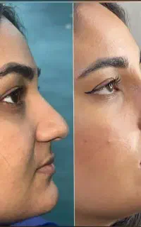 عمل بینی/لیپو ابدو /بلفارو/غبغب/لیزر co2 اقساط