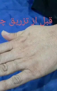ژل بوتاکس لیزر (تخفیف واقعی)