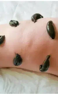 درآستاراوتالش زالودرمانی پذیرفته میشود
