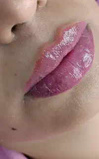 ژل بوتاکس فیلر