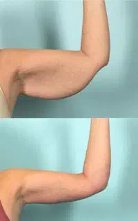 تخلیه چربی