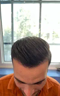 کاشت مو و ابرو طبیعی