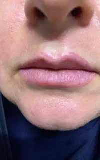 روشن کردن زیر بغل و بیکینی پاک کردن تاتو با لیزر