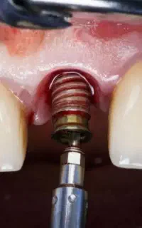 اگر بی‌دندونی اذیتت می‌کنه، این بهترین فرصته