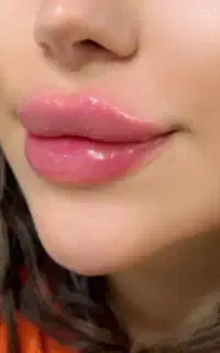 فیلرژل بوتاکس ۹۰۰