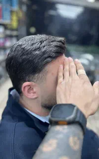 پروتز مو وارداتی با خط رویش عالی